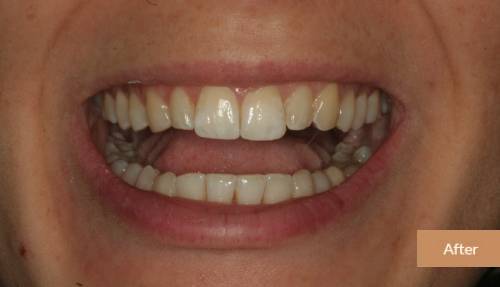 invisalign after 1