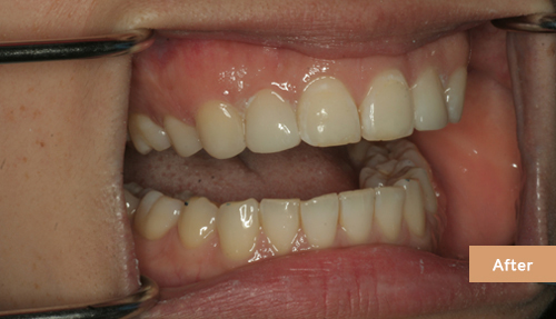 Invisalign and Bonding after 3