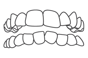 Crowded Teeth London Braces Clinic