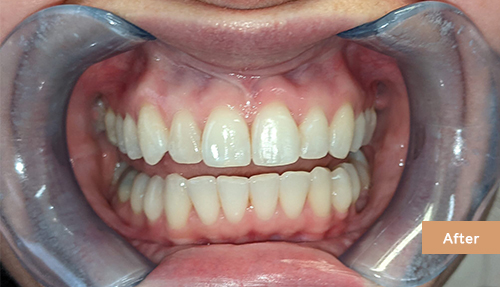 Invisalign and Contouring after 2