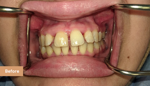 Invisalign and Contouring before 1