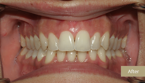 Invisalign and Teeth Whitening after