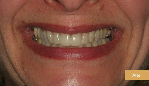 Invisalign and Bonding after 2
