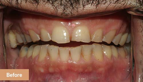 Teeth Reconstruction Before 1