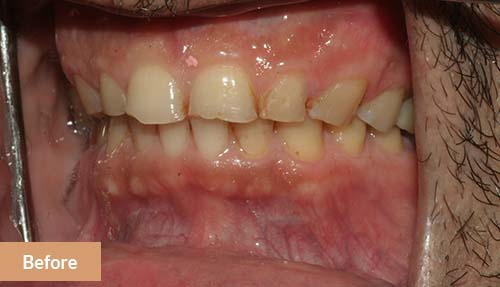 Teeth Reconstruction Before 2
