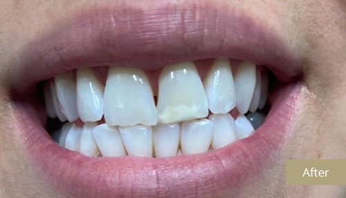 Teeth Whitening - After 2