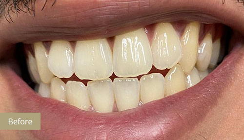 Teeth Whitening - Before 1