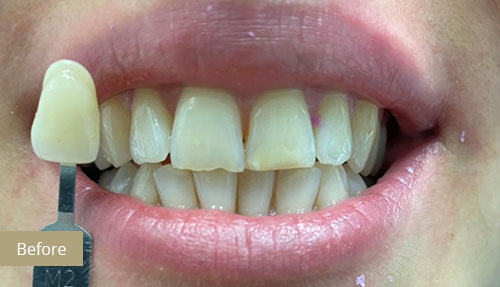 Teeth Whitening - Before 2