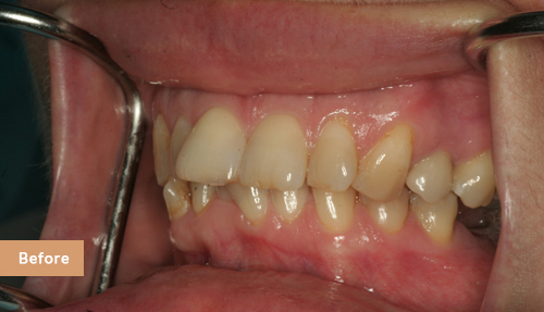 Upper veneers to better shape and alignment of teeth Before